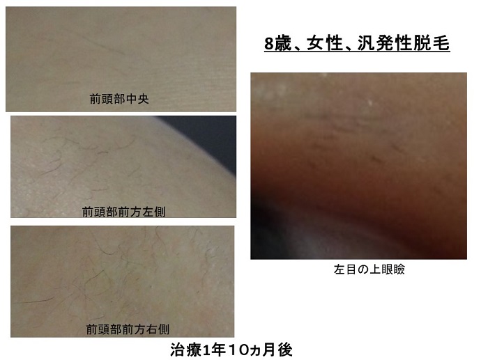 円形脱毛症　病院
